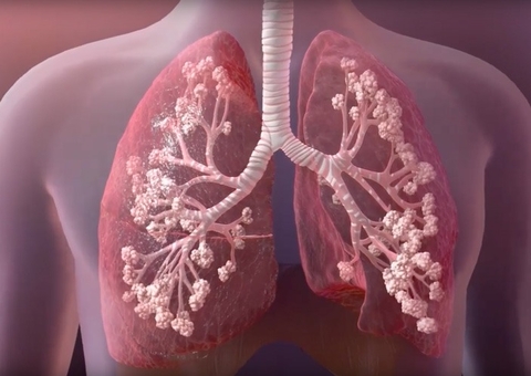 Fibrose cística: saiba mais sobre a doença do “Beijo Salgado”
