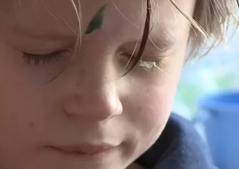 Criança fica 4 dias sem abrir o olho após pai confundir supercola com colírio