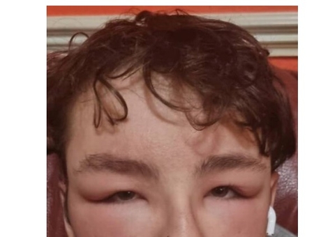 Adolescente tem rosto deformado após reação alérgica a óculos de videogame