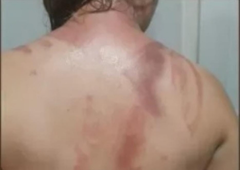 Envolvidos em trote de Universidade Federal que deixou 20 queimados podem ser expulsos