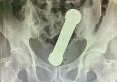 Homem usa peso de academia como ‘brinquedo sexual’ e vai parar no hospital em Manaus