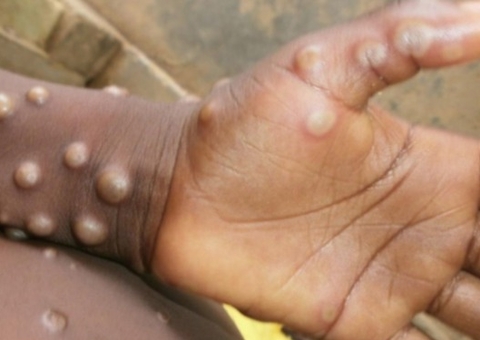 EUA identifica primeiro caso de infecção por varíola dos macacos 