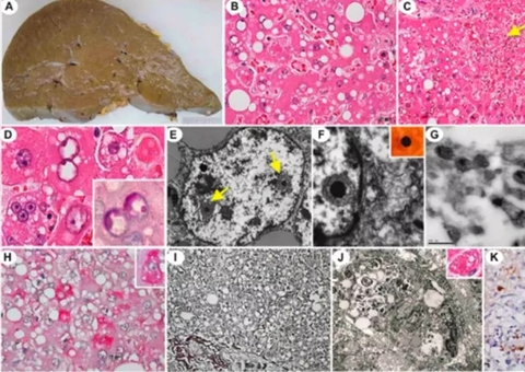 Vírus de alta letalidade ressurge no Brasil e alarma cientistas