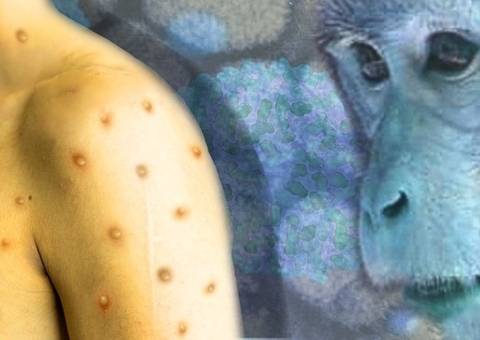 Brasil tem mais de 200 casos confirmados de varíola dos macacos