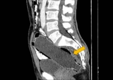 Homem esconde ‘brincadeira’ da esposa mas acaba no hospital com garrafa ‘entalada’ no ânus