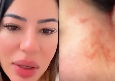 Influencer Milena Lins mostra rosto ensanguentado e acusa ex-namorado de agressão