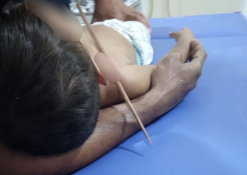 Bebê tem o peito atravessado por espeto de churrasco no Amazonas