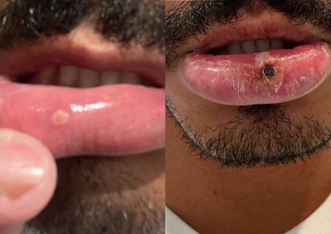 Advogado é diagnosticado com varíola dos macacos após achar que ferida era afta