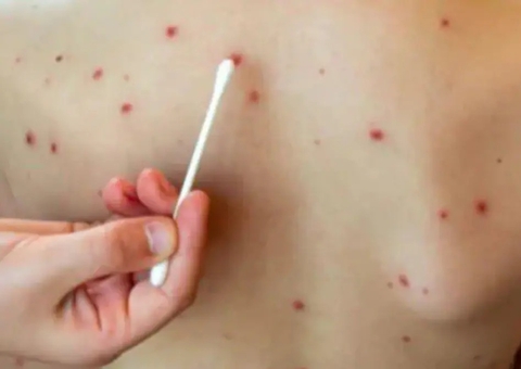 Gripe do tomate: veja 8 sintomas da infecção identificada em mais de 100 crianças na Índia