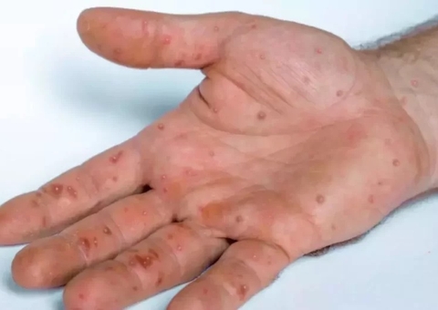 Anvisa autoriza uso emergencial de kits para varíola dos macacos