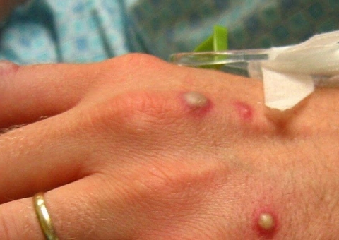 Rio de Janeiro registra primeira morte por varíola dos macacos; 2ª no País