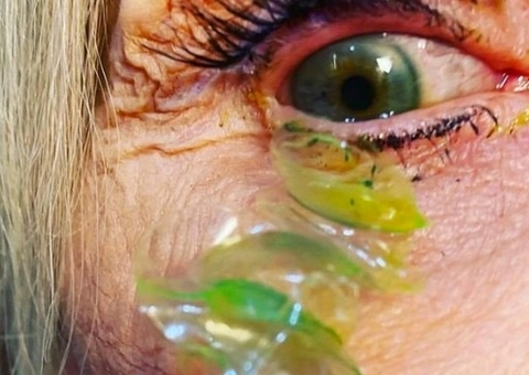 Vídeo: Oftalmologista retira mais de 20 lentes de contato perdidas em olho de paciente