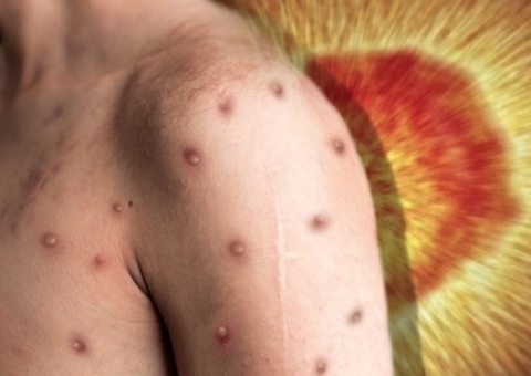 Amazonas tem 305 casos confirmados e 57 suspeitos de varíola dos macacos