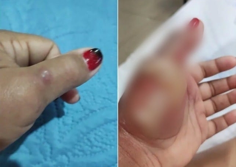 Mulher fica com tendão exposto após ser picada por aranha-marrom