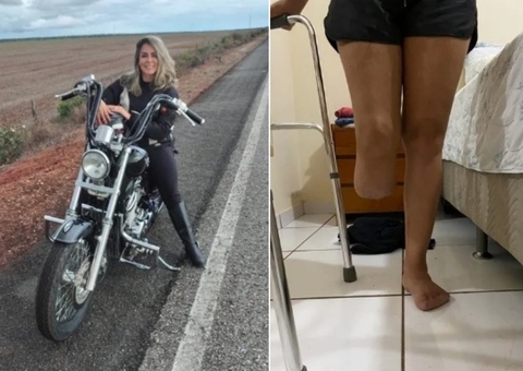 Mulher perde a perna e vários dedos após passar por lipoaspiração e entrar em coma