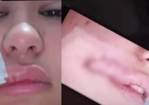 Homem arranca rosto de mulher a dentadas durante assalto