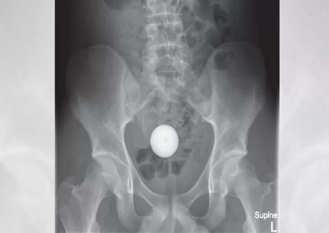 Adolescente enfia bola no próprio ânus e passa perrengue para objeto sair