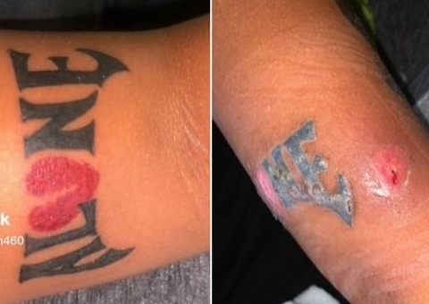 Braço de jovem ‘apodrece’ após tatuagem