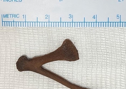 Mulher é levada às pressas para hospital após osso de galinha ficar preso no ânus