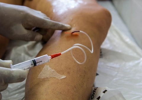 No Brasil mais de 45 mil mulheres foram internadas por varizes em 2022