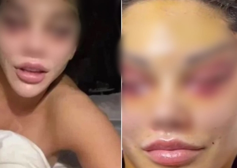 Influencer fica com o rosto deformado após cirurgia para ter 'olhos de gata': 'assustador'
