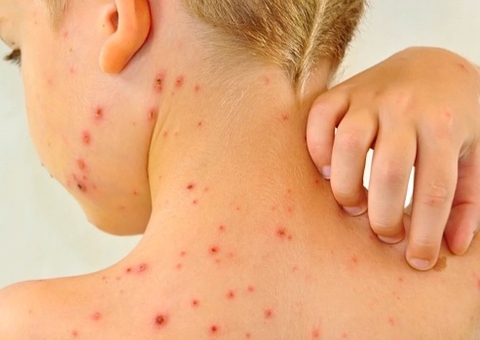 Morte de brasileiro com catapora acende alerta sobre doença; entenda