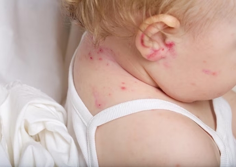 Pesquisa mostra que crianças alérgicas têm mais tendências para desenvolver outras alergias