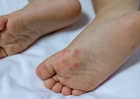 Síndrome Mão-Pé-Boca: saiba como prevenir e os cuidados com o vírus