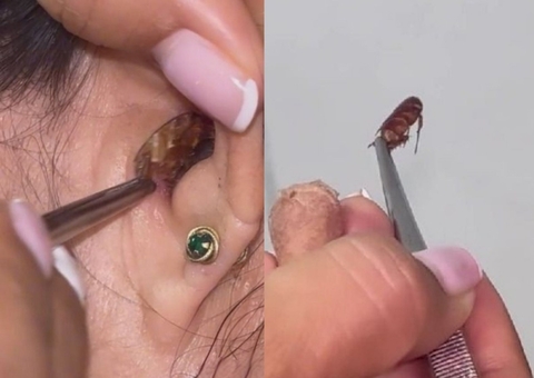 Médica retira barata viva do ouvido de paciente e vídeo viraliza