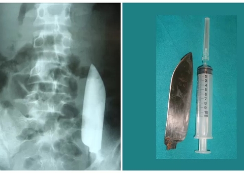 Jovem é esfaqueado em briga de bar e sobrevive ao ser deixado com faca dentro da barriga