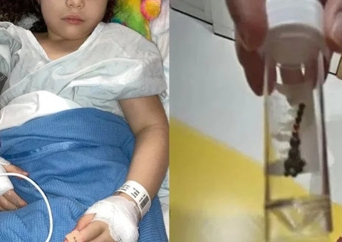 Menina perde parte do intestino após engolir bolas magnéticas