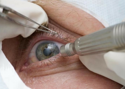 Fungo causou infecção de 104 pessoas após mutirão de cirurgias; 7 perderam globo ocular