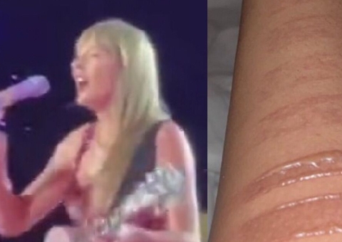 Fã de Taylor Swift mostra queimadura na perna após empurra-empurra no Engenhão
