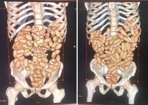 De convulsões a morte: Saiba riscos de transportar drogas no estômago, ânus ou vagina