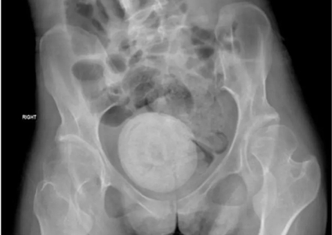 Mulher tem pedra do tamanho de laranja retirada da vagina