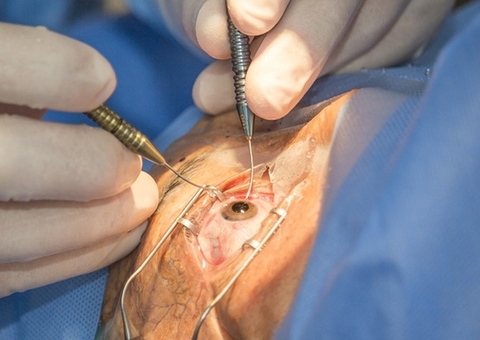 Manaus tem mutirão de cirurgias de cataratas neste fim de semana