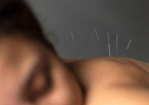 Disponível no SUS, acupuntura ajuda a aliviar cólicas menstruais