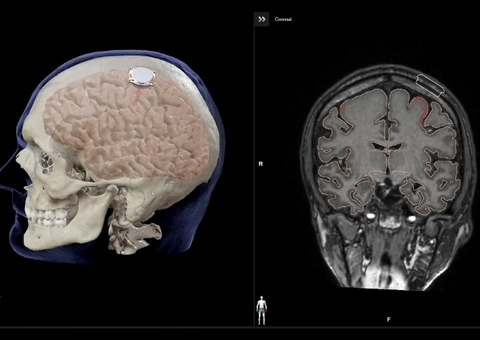 Chip cerebral de Elon Musk é implantado em humano pela primeira vez