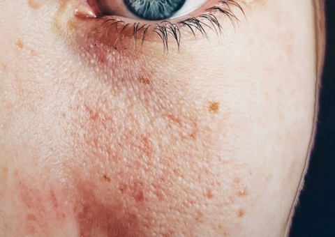 Câncer de pele: aprenda a identificar pintas suspeitas