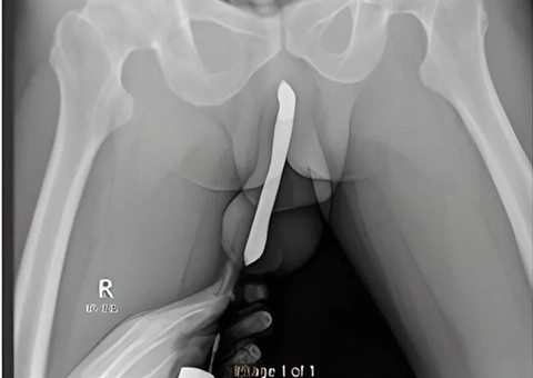 Homem enfia escova de dentes no pênis e vai parar no hospital