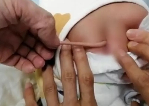 Bebê nasce com ‘cauda’ de 10 cm; entenda condição rara