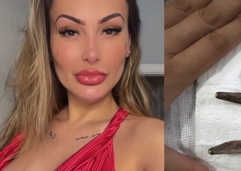 Andressa Urach posta foto das costelas retiradas: 'que lindas'
