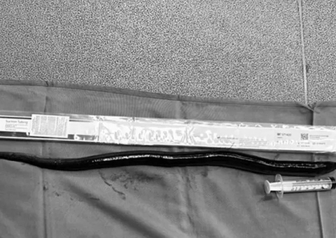 Enguia viva é retirada de barriga de homem; médicos especulam por onde animal entrou