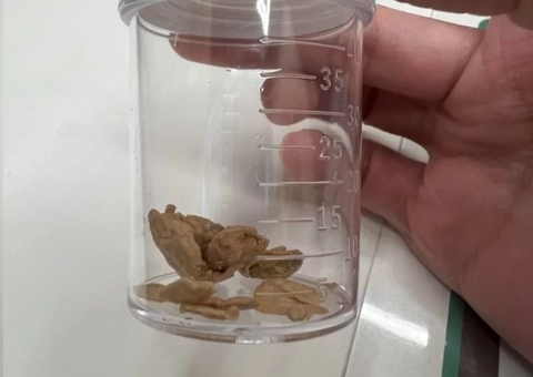 Homem fica com pedras de esmegma após passar 30 anos sem lavar o pênis