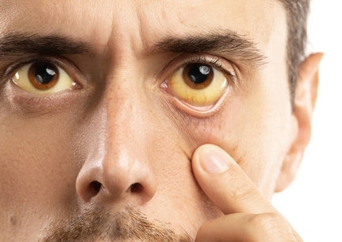 Hepatites virais matam 3,5 mil por dia no mundo, alerta OMS