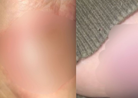 Fotos mostram como ficaram pés de bebê queimado com colher quente pela madrasta em Manaus