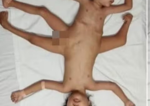 Gêmeos nascem com três pernas e quatro braços após gravidez 'normal'