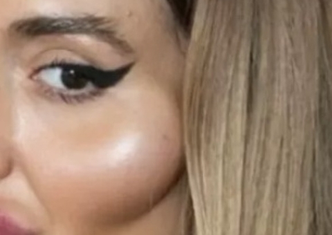 Mulher com as maiores bochechas do mundo faz novo procedimento no rosto