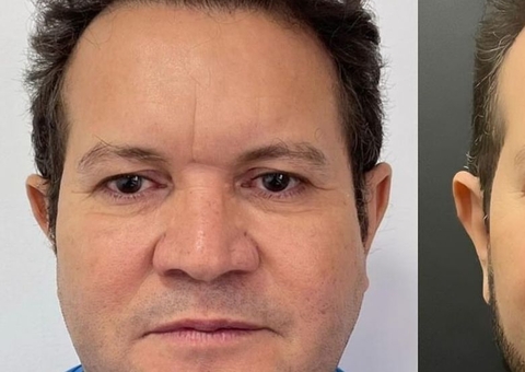 Ximbinha faz harmonização facial; veja antes e depois