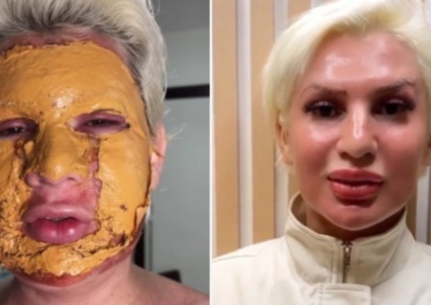 Romagaga fez peeling de fenol na mesma clínica envolvida em caso de morte